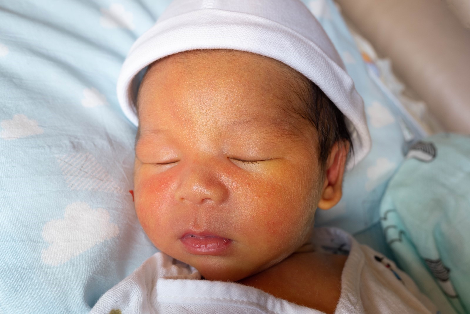 All About Neonatal Jaundice 