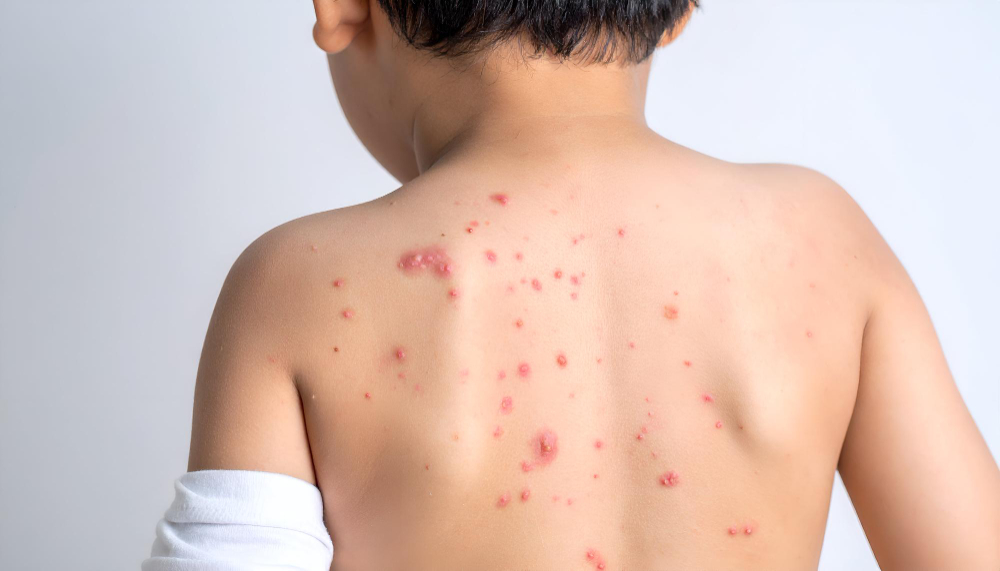 Common Myths About Chickenpox (Varicella) in Children: Separating Fact from Fiction